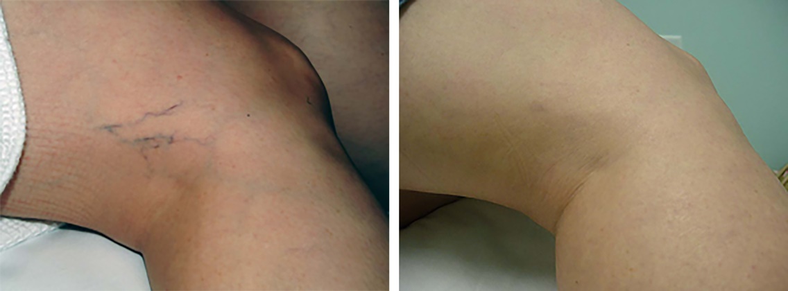 Laser-Vein-treatment