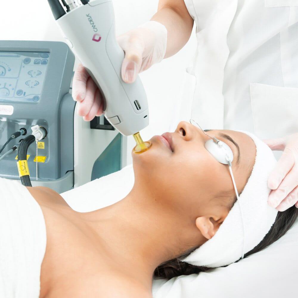 Laser treatment