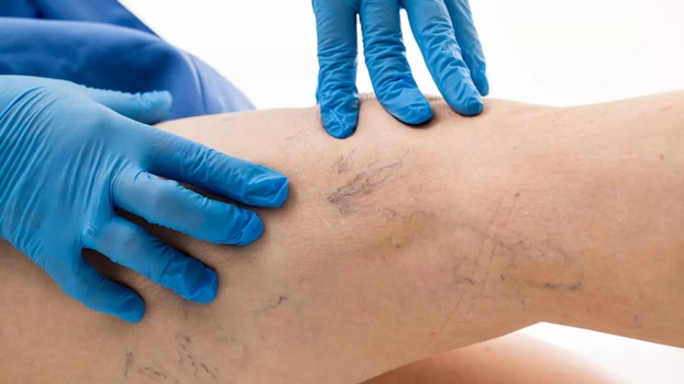 vascular-treatment